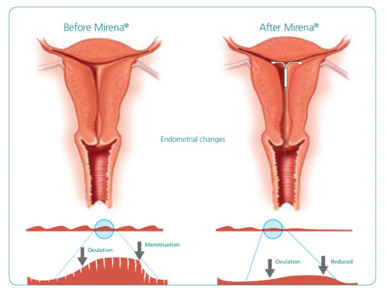 Mirena uterus before and after